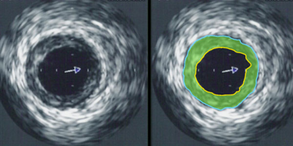 Intravascular Ultrasound (IVUS) in Nagpur