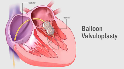 Balloon Valvuloplasty