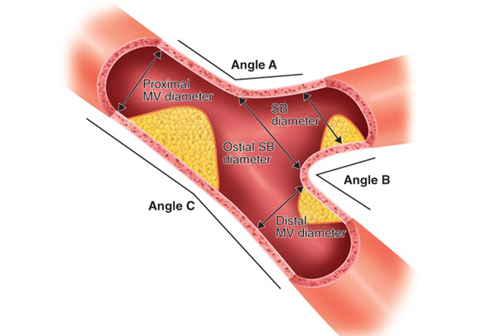 Bifurcation Percutaneous Coronary Intervention