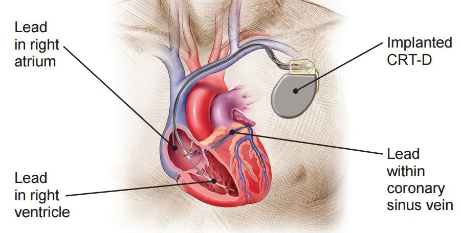 Cardiac Resynchronization Therapy