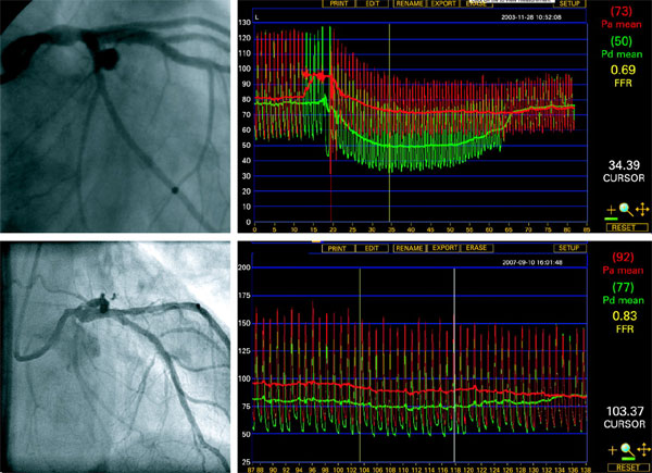 FFR/RFR (Fractional Flow Reserve)