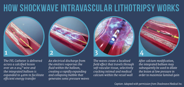 Intravascular Lithotripsy