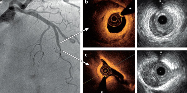 Optical Coherence Tomography