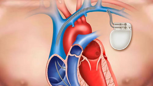 Pacemaker Implantation