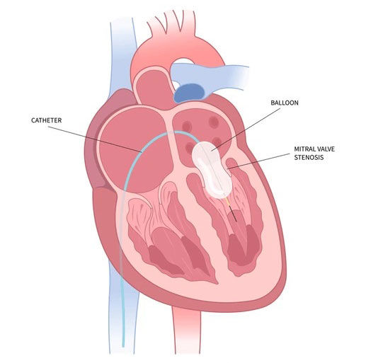 Percutaneous Balloon Mitral Valvuloplasty