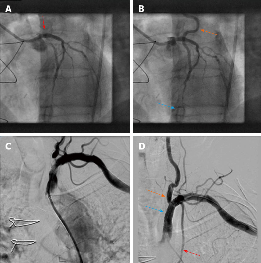 Left Main Percutaneous Coronary Intervention