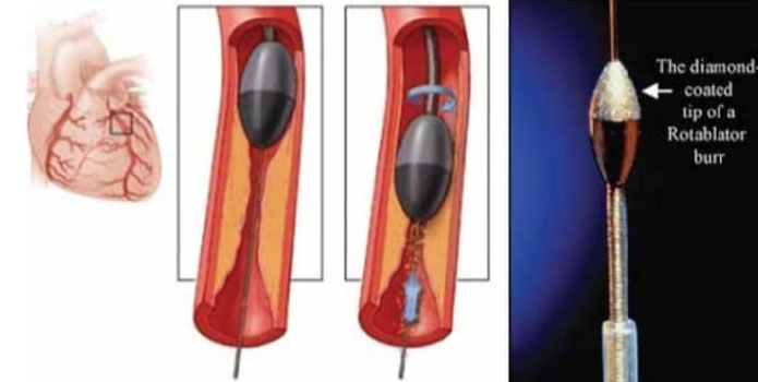 Rotablation Angioplasty in Nagpur