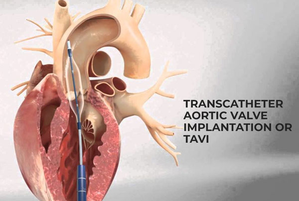 Transcatheter Aortic Valve Implantation